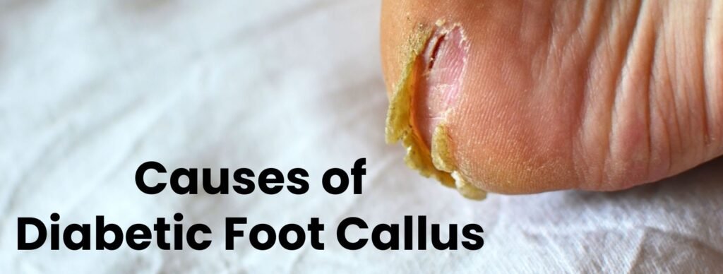 Causes of Diabetic Foot Callus