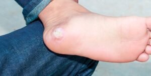Diabetic Foot Callus
