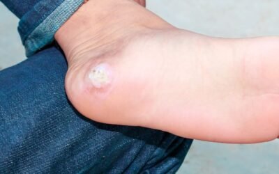 Diabetic Foot Callus: Causes, Symptoms, Prevention, and Treatment