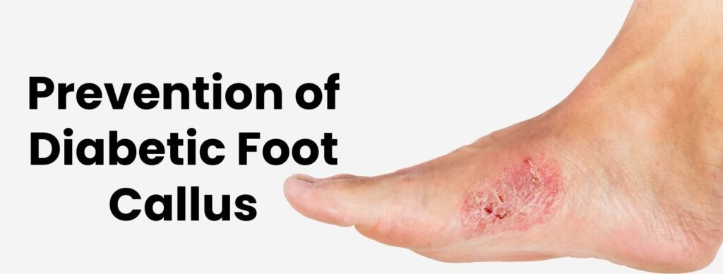 Prevention of Diabetic Foot Callus