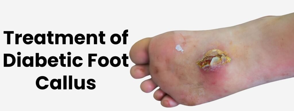 Treatment of Diabetic Foot Callus