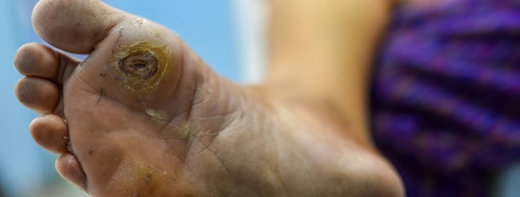 What is Diabetic Foot Callus